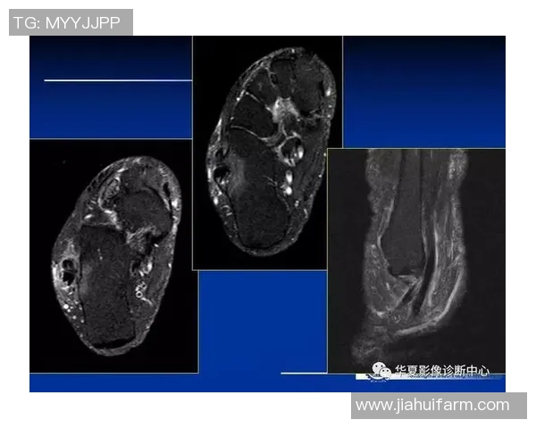 足球意外撞击脚踝的伤害与恢复之路探讨
